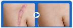 Scar Removal Phototherapy Pen – Asia’s Best-Selling Expert-Recommended Device for Fading Old Scars & Stretch Marks