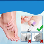 Antifungal Laser Device - Nail Fungus Treatment Pen Anti-fungal Repair Pen Blue Light Laser Pen