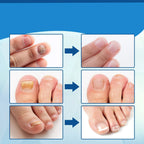 Antifungal Laser Device - Nail Fungus Treatment Pen Anti-fungal Repair Pen Blue Light Laser Pen